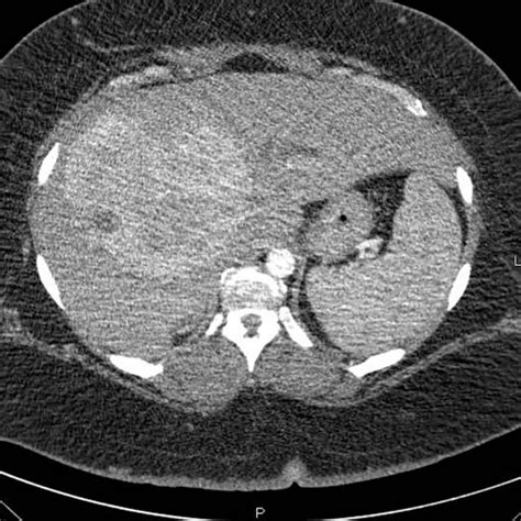 A Triple Phase Helical Ct Scan Shows A 14 Cm Hypervascular