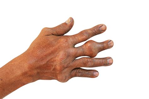 Dasar jari di telapak tangan, di mana mereka muncul benjolan seukuran kacang kecil. Info Tentang Penyakit Gout Yang Anda Wajib Tahu - Bidadari.My