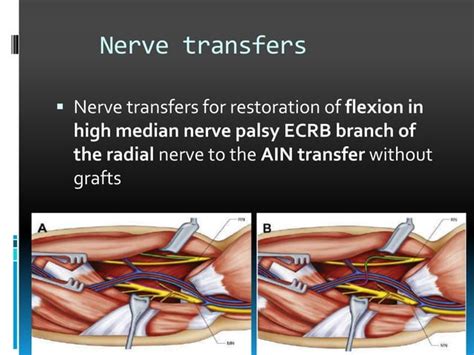 Median Nerve Injury Ppt