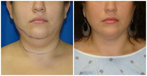Chin Lipo Price How Do You Price A Switches