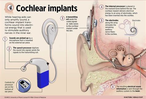 Cochlear Implants Cochlear Cochlear Implant Audiology Student