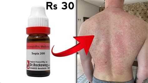 Tinea Versicolor सेहुआ Best Homeopathic Madicine Sehuwa Ka Ilaj Youtube