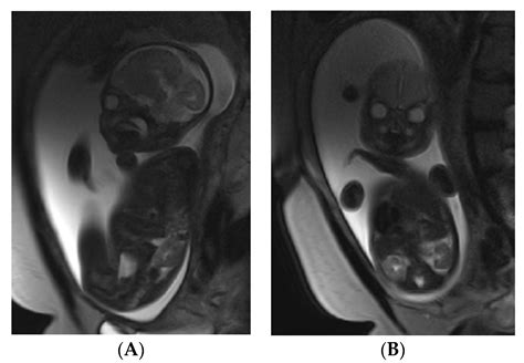 Medicina Free Full Text Use Of Magnetic Resonance Imaging In Evaluating Fetal Brain And