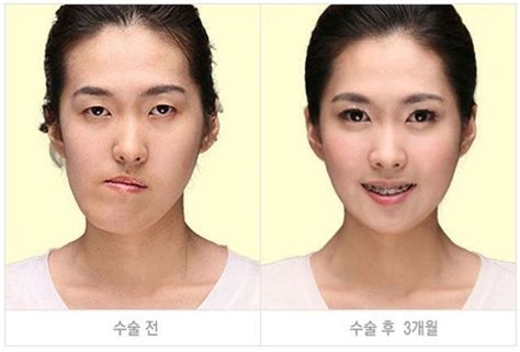 Before And After Plastic Surgery Plastische Chirurgie Koreanische