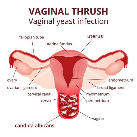 Developing a yeast infection during pregnancy is common. Vaginal Yeast Infection Symptoms, Treatment | STD Vaginal ...