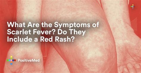 What Are The Symptoms Of Scarlet Fever Do They Include A Red Rash