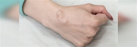 Ultrasound Guided Ganglion Cysts Assessment Los Angeles CA USA SIFSOF