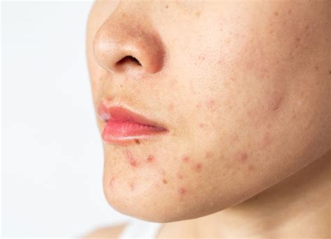 How To Get Rid Of Spots And What Spots On Different Areas Of Your Face Mean
