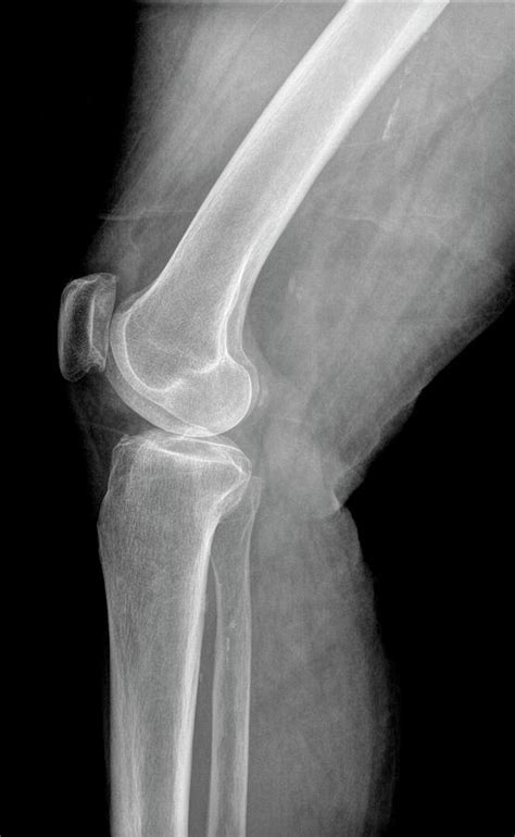 Calcified Knee Joint Photograph By Photostock Israelscience Photo Library