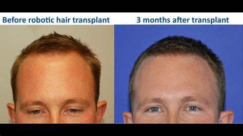 Hair loss due to measurable deficiencies may be supported by replacement therapy but supplements in the form of vitamins are not proved for hair loss. 3 Months After Robotic Hair Transplant: Patient is ...