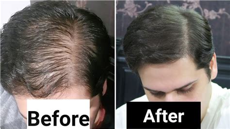 It also contains amino acid tryptophan, sterols, triterpenes, lignans, and tannins. Rosemary Oil for Hair Loss - My Results w/ Pictures Before ...