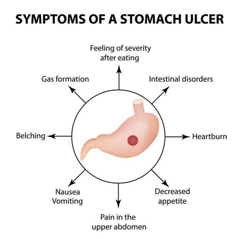 Stomach Ulcer Gastric Ulcer Overview Signs And Symptoms Causes
