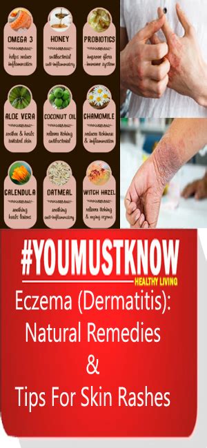 Eczema Dermatitis Natural Remedies And Tips For Skin Rashes World Of