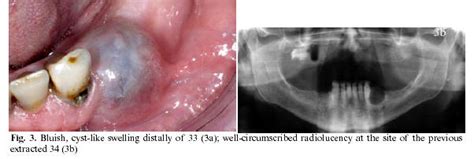 An Unusual Clinicoradiographic Presentation Of A Lateral Periodontal