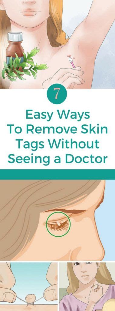 7 easy ways to remove skin tags without seeing a doctor with images skin tag removal health