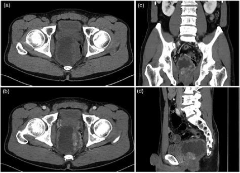 Abdominal Ct Scan At The Level Of The Pelvis Showing A Large Mass At