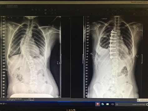 Before And After Surgery Scoliosis