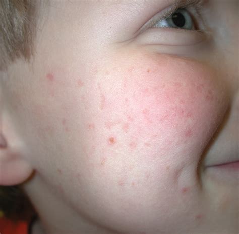 Collection Images Keratosis Pilaris On Face Pictures Full Hd K K
