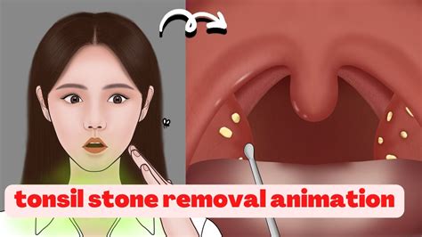 Asmr What Caused Bad Breath Satisfying White Tongue And Tonsil Stones