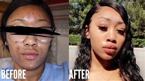 My Skincare Routine How I Cleared My Acne And Dark Spots Youtube
