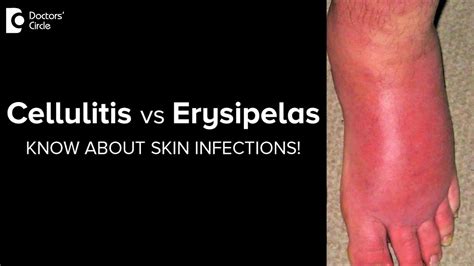 Cellulitis Vs Erysipelas Know More About These Skin Infections Dr Rajdeep Mysore Doctors