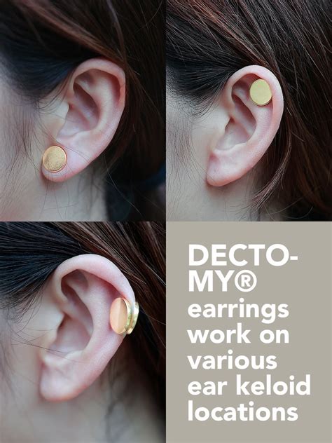 Keloid Compression Earring Clip Cheloide Ear Compression For Etsy