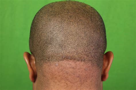 Details More Than 67 Ingrown Hair Follicle On Head Super Hot Ineteachers