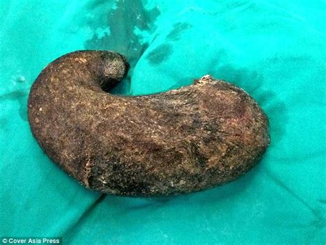 doctors remove huge hairball from teen s stomach as she can t stop chewing her hair relay hero
