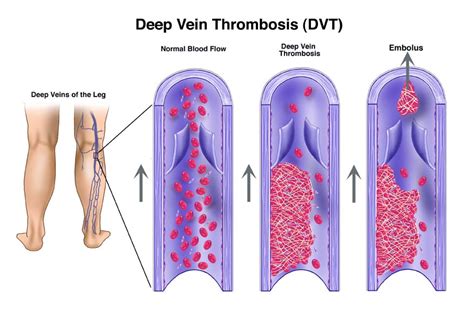 Dr Castro Explains What You Can Do To Prevent Deep Vein Thrombosis