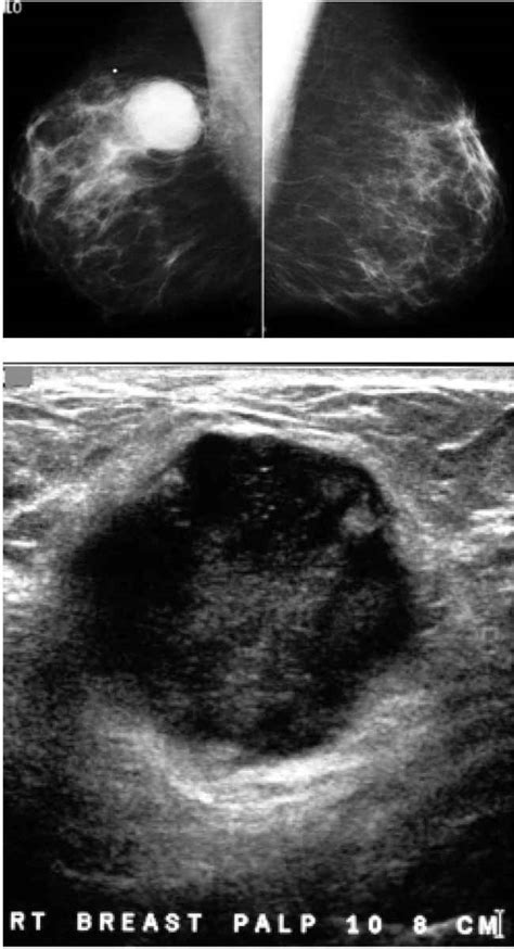 Evaluation And Imaging Features Of Malignant Breast Masses Radiology Key