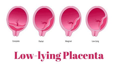 Low Lying Placenta