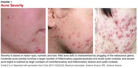 Pharmacologic Therapy For Acne A Primer For Primary Care Clinician