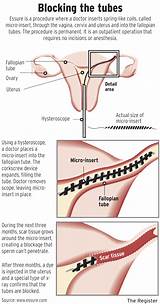 Images of Coils In Fallopian Tubes Side Effects