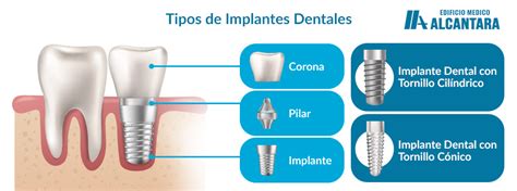 Conozca los Tipos de Implantes Dentales Recomendados por la Agrupación