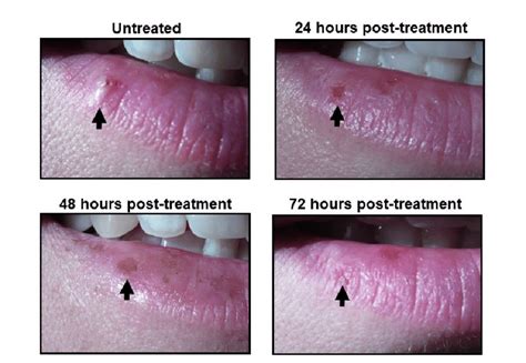 Photographs Of Herpes Labialis Lesions During Treatment Photos Show