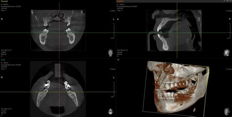 The Example Of Cbct Imaging Including Cross Sectional View Showing The