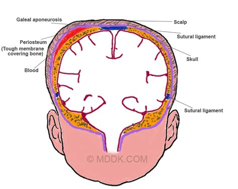 Cephalohematoma Definition Causes Symptoms Pictures Treatment