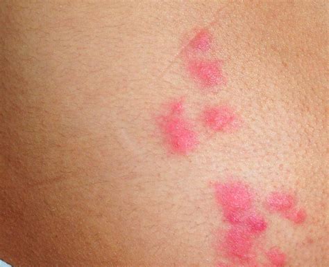 Insect Bites Reactions Types And Images Free Download Nude Photo Gallery