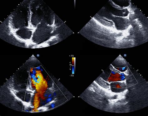 Echocardiogram