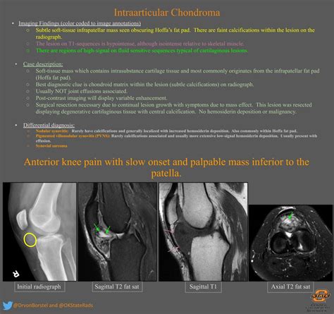 Intraarticular Chondroma Msk Radiology Imaging Findings Grepmed