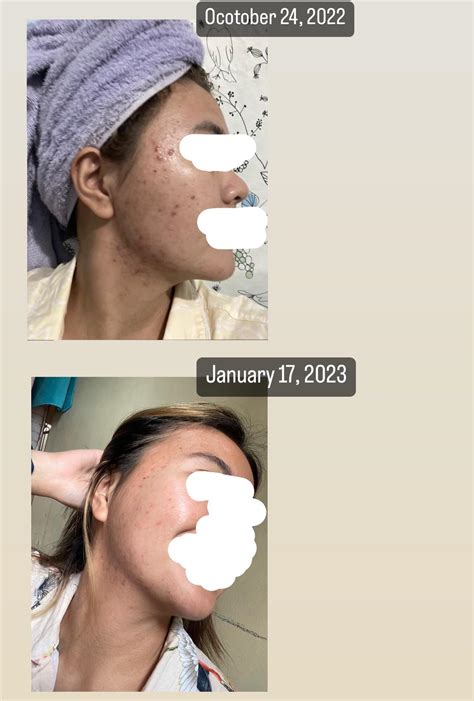 3 Months Apart My Isotretinoin Journey Rbeautytalkph