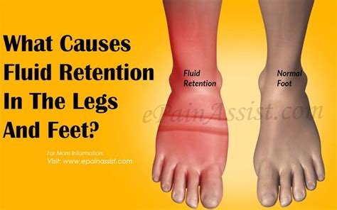 Image Result For Fluid Retention Swelling In Legs Fluid Retention