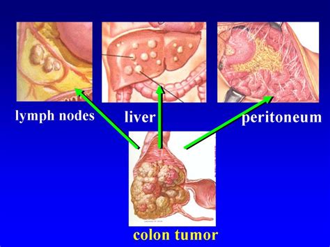 What Is Peritoneum And Peritoneal Cancer My Gynae