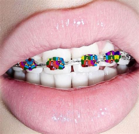 Pin By Hobart Lutz On Pulling Teeth Braces Colors Pink Braces Dental Braces