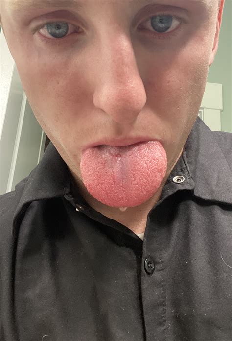 Man films his massively swollen tongue after he was stung by a bee ...