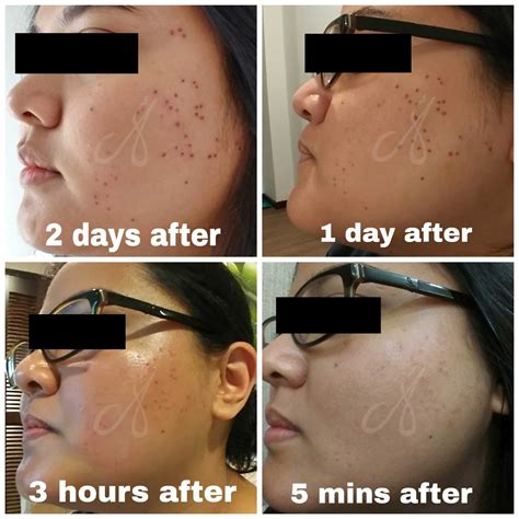 Dermatosis Papulosa Nigra Dpn Treatment In Alainn Clinic Kuala Lumpur