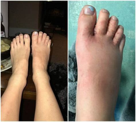 Young Couple Contracts Hookworms In Feet At Punta Cana Beach Resort