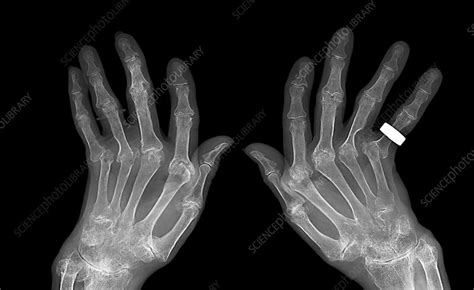 Rheumatoid Arthritis X Ray Stock Image C Science Photo