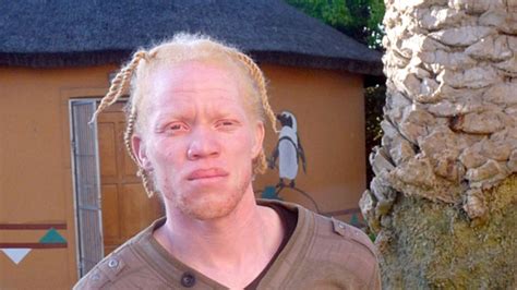 T Dlicher Aberglauben Bedroht Albinos In Afrika Welt