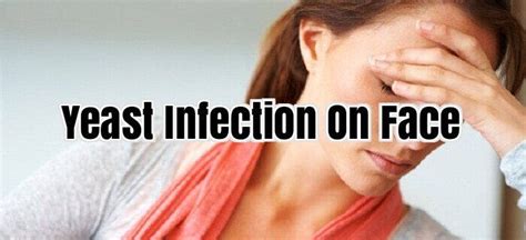 Yeast Infection On Face Yeastinfection Yeast Infection Face